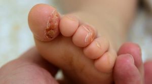 ezema in children foot helthstyle pharmacy