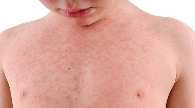 Read more about the article Eczema in Children